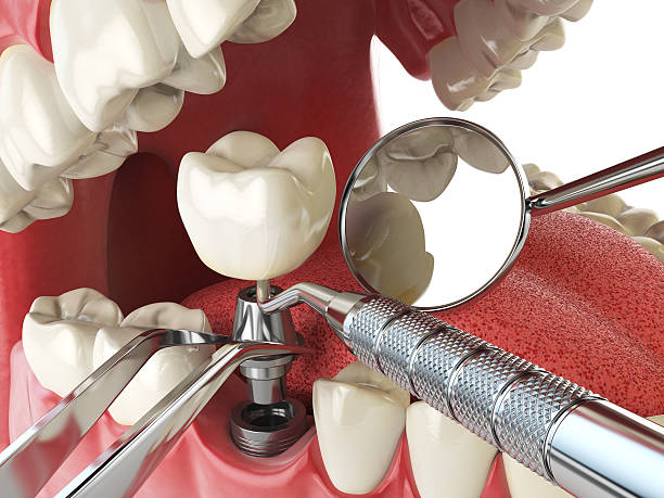 Best Dental Abscess Treatment in Fortuna, CA